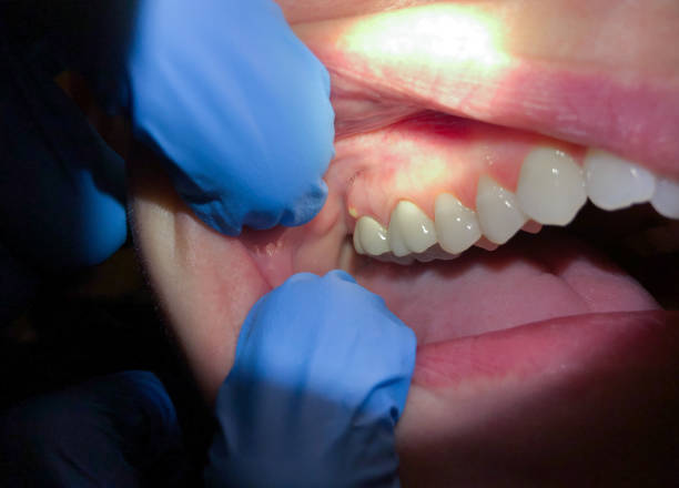 Best Broken or Cracked Tooth Emergency Dentist in West Little River, FL